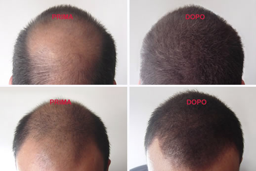 Crescita di capelli nella persona a donne della ragione trattamento da rimedi di gente